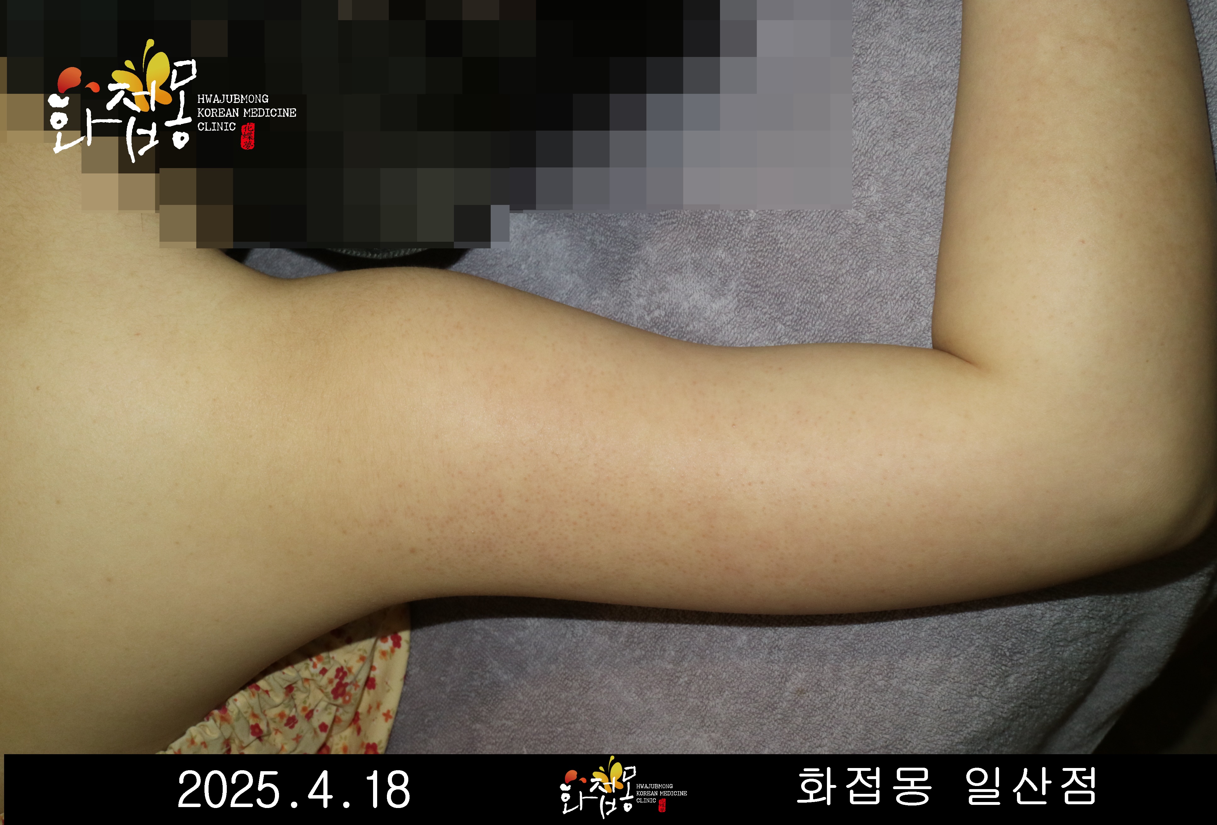 전후사진