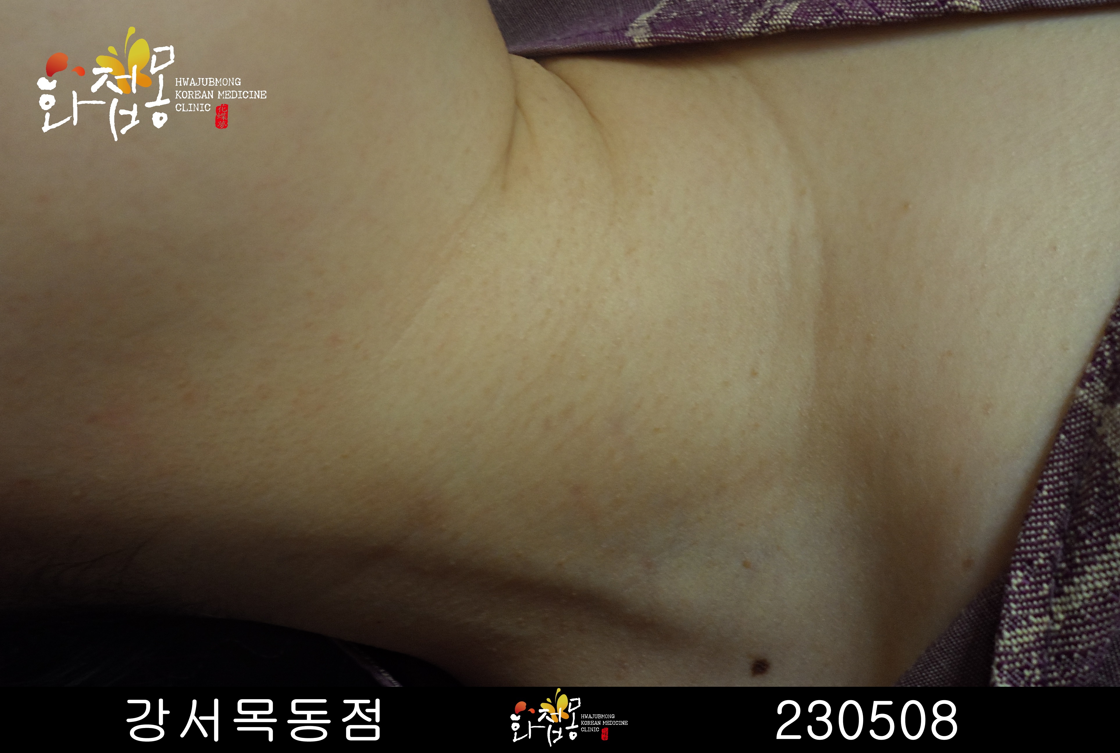 전후사진