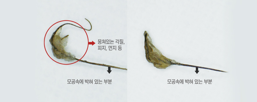 모공각화증